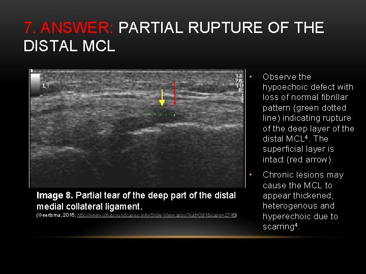 7. ANSWER: PARTIAL RUPTURE OF THE DISTAL MCL Image 8. Partial tear of the