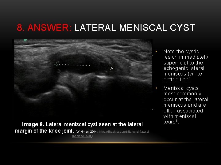 8. ANSWER: LATERAL MENISCAL CYST Image 9. Lateral meniscal cyst seen at the lateral