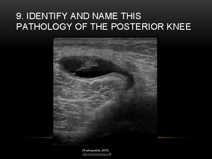 9. IDENTIFY AND NAME THIS PATHOLOGY OF THE POSTERIOR KNEE (Radiopaedia, 2015; http: //radiopaedia.