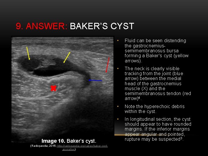 9. ANSWER: BAKER’S CYST Image 10. Baker’s cyst. (Radiopaedia, 2015; http: //radiopaedia. org/cases/baker-cystaspiration) •