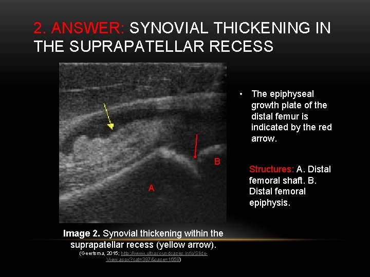 2. ANSWER: SYNOVIAL THICKENING IN THE SUPRAPATELLAR RECESS • The epiphyseal growth plate of