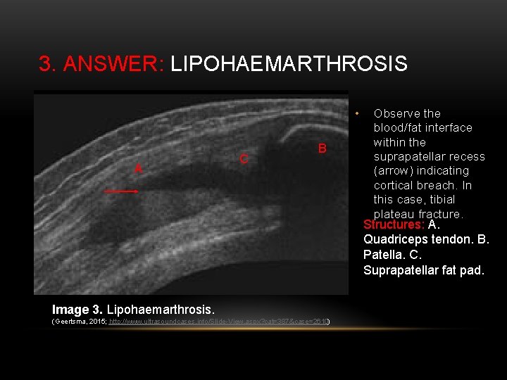 3. ANSWER: LIPOHAEMARTHROSIS • A C B Observe the blood/fat interface within the suprapatellar