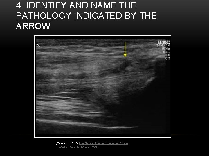 4. IDENTIFY AND NAME THE PATHOLOGY INDICATED BY THE ARROW (Geertsma, 2015; http: //www.