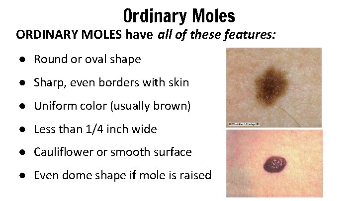 Ordinary Moles ORDINARY MOLES have all of these features: ● Round or oval shape Ordinary Moles ORDINARY MOLES have all of these features: ● Round or oval shape