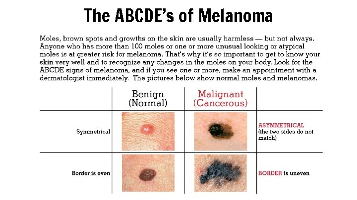 The ABCDE’s of Melanoma 