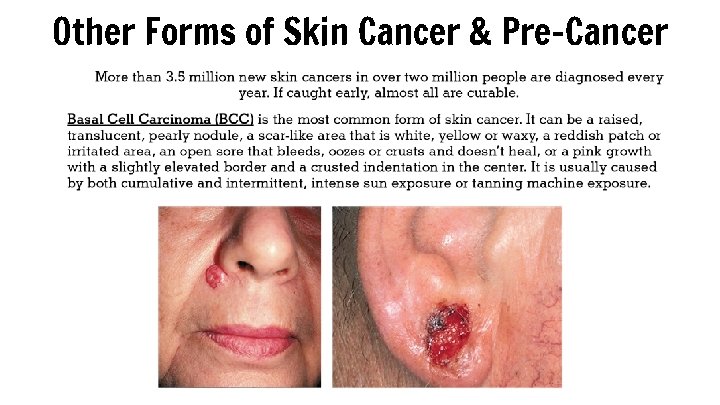 Other Forms of Skin Cancer & Pre-Cancer 