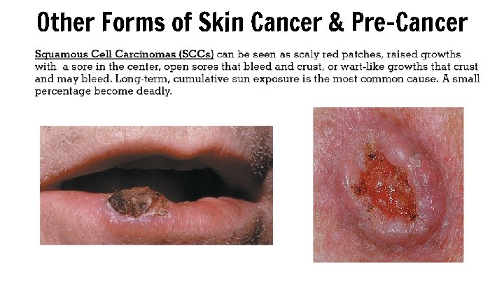 Other Forms of Skin Cancer & Pre-Cancer 