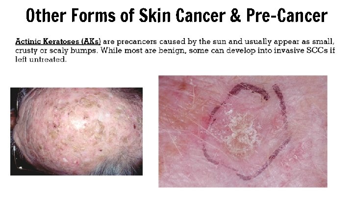 Other Forms of Skin Cancer & Pre-Cancer 