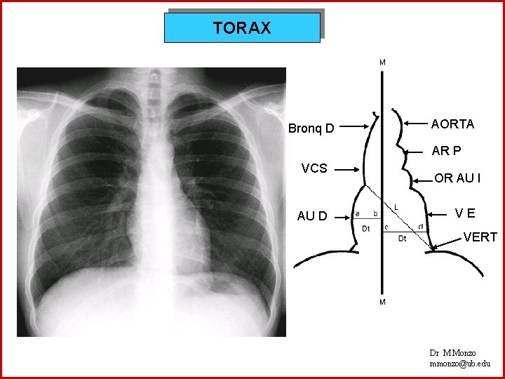 TORAX Bronq D AORTA AR P VCS AU D OR AU I VE VERT