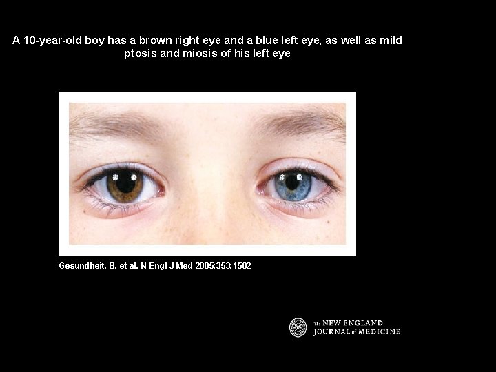A 10 -year-old boy has a brown right eye and a blue left eye,