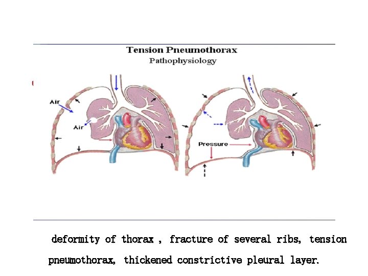 ▲ ● decreased lung compliance decrease of pulmonary surfactants and increase of surface tension