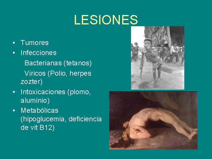 LESIONES • Tumores • Infecciones Bacterianas (tetanos) Viricos (Polio, herpes zozter) • Intoxicaciones (plomo,