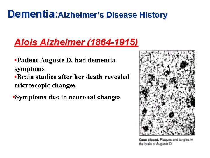 Dementia: Alzheimer’s Disease History Alois Alzheimer (1864 -1915) • Patient Auguste D. had dementia Dementia: Alzheimer’s Disease History Alois Alzheimer (1864 -1915) • Patient Auguste D. had dementia
