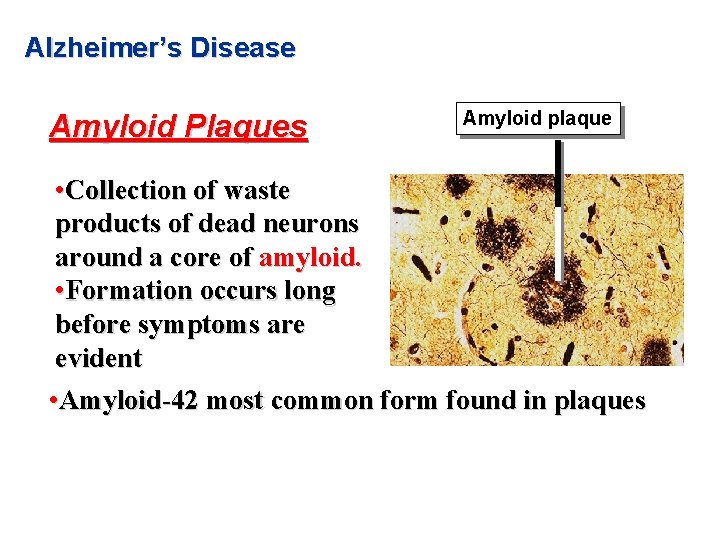 Alzheimer’s Disease Amyloid Plaques Amyloid plaque • Collection of waste products of dead neurons Alzheimer’s Disease Amyloid Plaques Amyloid plaque • Collection of waste products of dead neurons