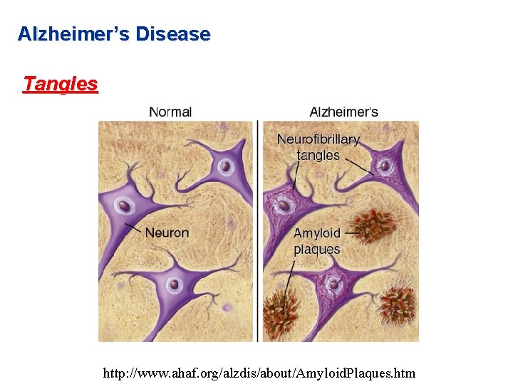 Alzheimer’s Disease Tangles http: //www. ahaf. org/alzdis/about/Amyloid. Plaques. htm Alzheimer’s Disease Tangles http: //www. ahaf. org/alzdis/about/Amyloid. Plaques. htm