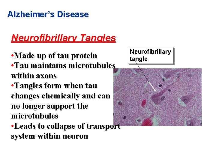 Alzheimer’s Disease Neurofibrillary Tangles • Made up of tau protein • Tau maintains microtubules Alzheimer’s Disease Neurofibrillary Tangles • Made up of tau protein • Tau maintains microtubules