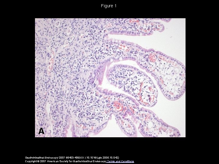 Figure 1 Gastrointestinal Endoscopy 2007 65403 -409 DOI: (10. 1016/j. gie. 2005. 10. 042)