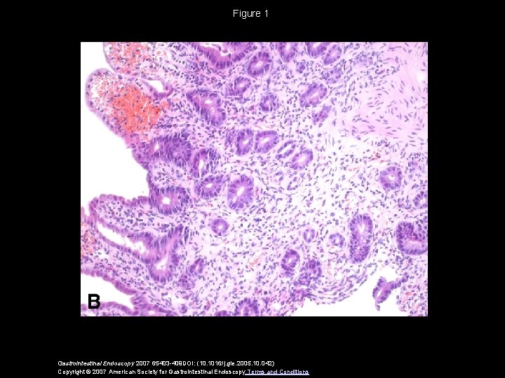 Figure 1 Gastrointestinal Endoscopy 2007 65403 -409 DOI: (10. 1016/j. gie. 2005. 10. 042)