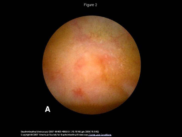 Figure 2 Gastrointestinal Endoscopy 2007 65403 -409 DOI: (10. 1016/j. gie. 2005. 10. 042)