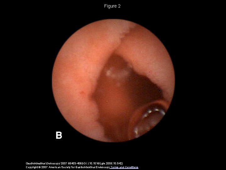 Figure 2 Gastrointestinal Endoscopy 2007 65403 -409 DOI: (10. 1016/j. gie. 2005. 10. 042)