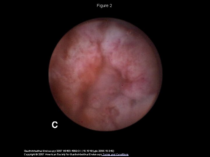Figure 2 Gastrointestinal Endoscopy 2007 65403 -409 DOI: (10. 1016/j. gie. 2005. 10. 042)