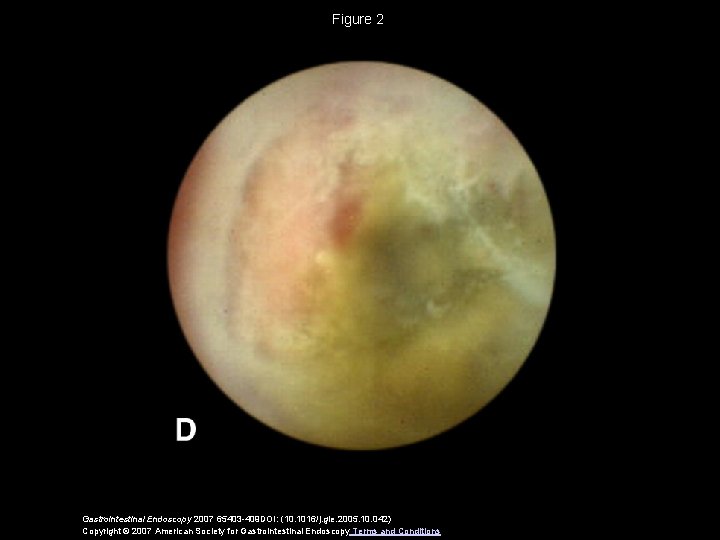 Figure 2 Gastrointestinal Endoscopy 2007 65403 -409 DOI: (10. 1016/j. gie. 2005. 10. 042)