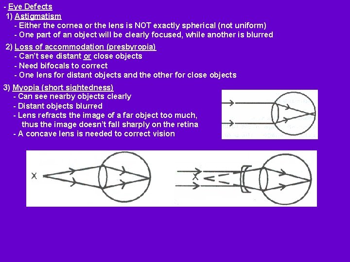 - Eye Defects 1) Astigmatism - Either the cornea or the lens is NOT