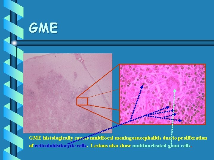 GME histologically causes multifocal meningoencephalitis due to proliferation of reticulohistiocytic cells. Lesions also show