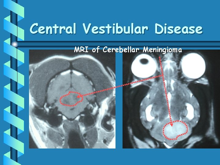 Central Vestibular Disease MRI of Cerebellar Meningioma 