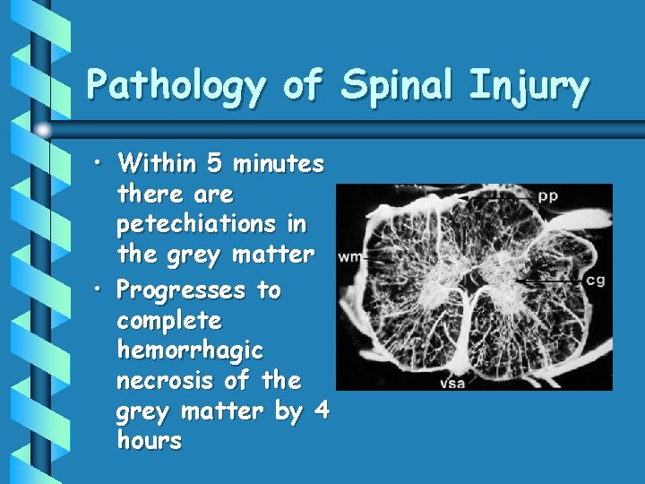 Pathology of Spinal Injury • Within 5 minutes there are petechiations in the grey