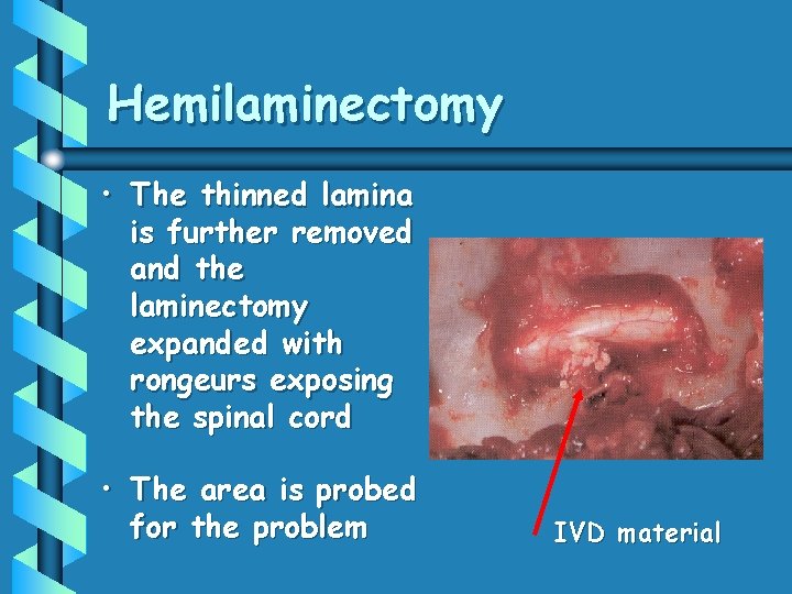 Hemilaminectomy • The thinned lamina is further removed and the laminectomy expanded with rongeurs