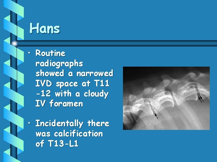 Hans • Routine radiographs showed a narrowed IVD space at T 11 -12 with