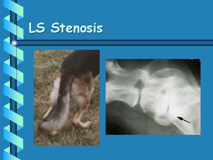 LS Stenosis 