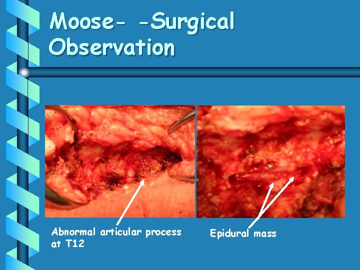 Moose- -Surgical Observation Abnormal articular process at T 12 Epidural mass 