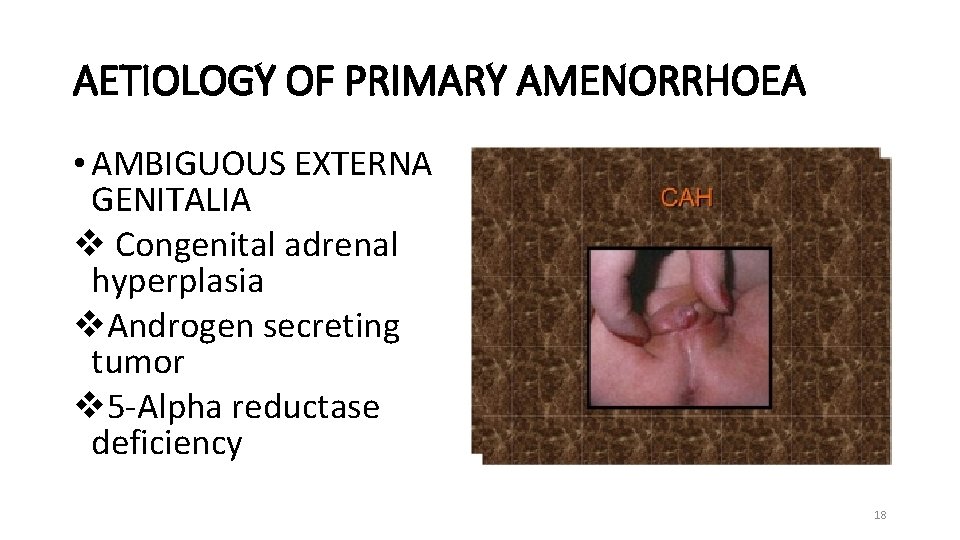 AETIOLOGY OF PRIMARY AMENORRHOEA • AMBIGUOUS EXTERNA GENITALIA v Congenital adrenal hyperplasia v. Androgen