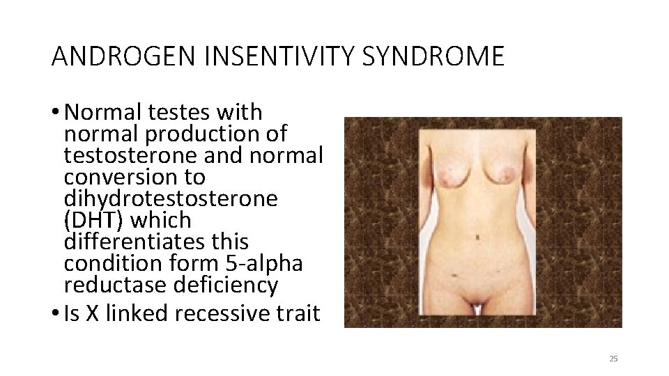 ANDROGEN INSENTIVITY SYNDROME • Normal testes with normal production of testosterone and normal conversion