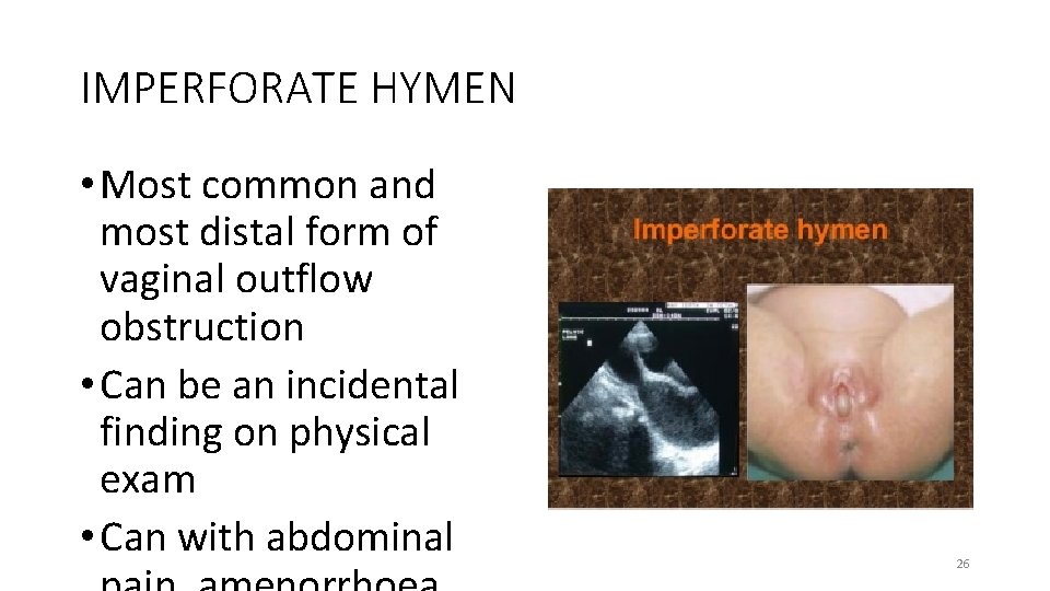 IMPERFORATE HYMEN • Most common and most distal form of vaginal outflow obstruction •