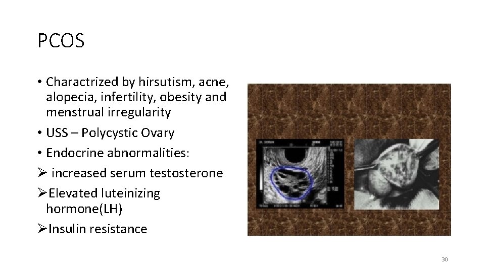 PCOS • Charactrized by hirsutism, acne, alopecia, infertility, obesity and menstrual irregularity • USS