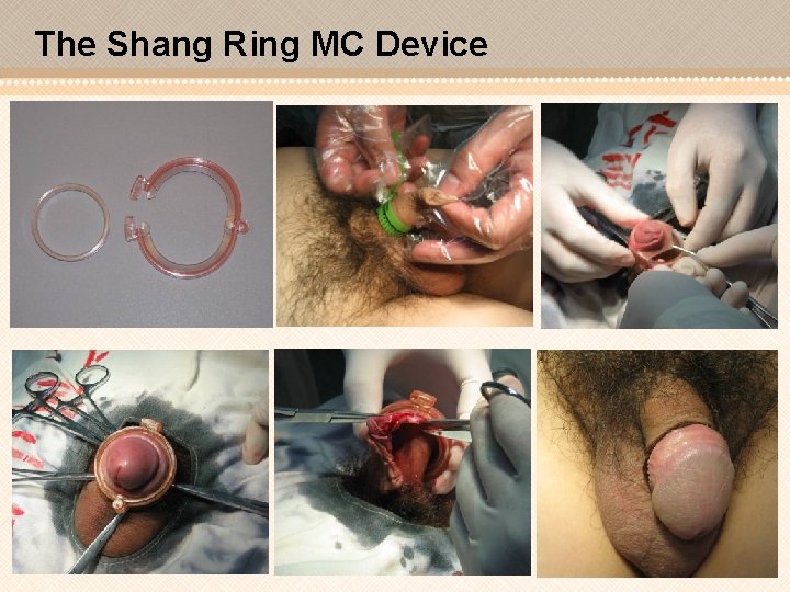 The Shang Ring MC Device 