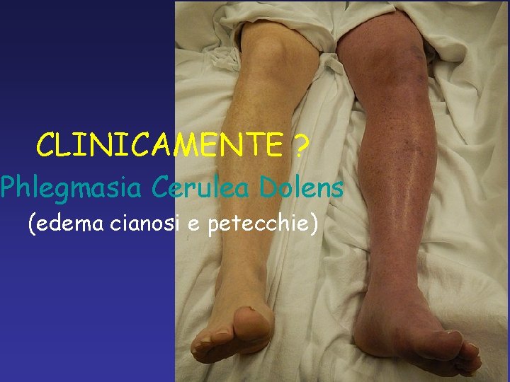 CLINICAMENTE ? Phlegmasia Cerulea Dolens (edema cianosi e petecchie) 
