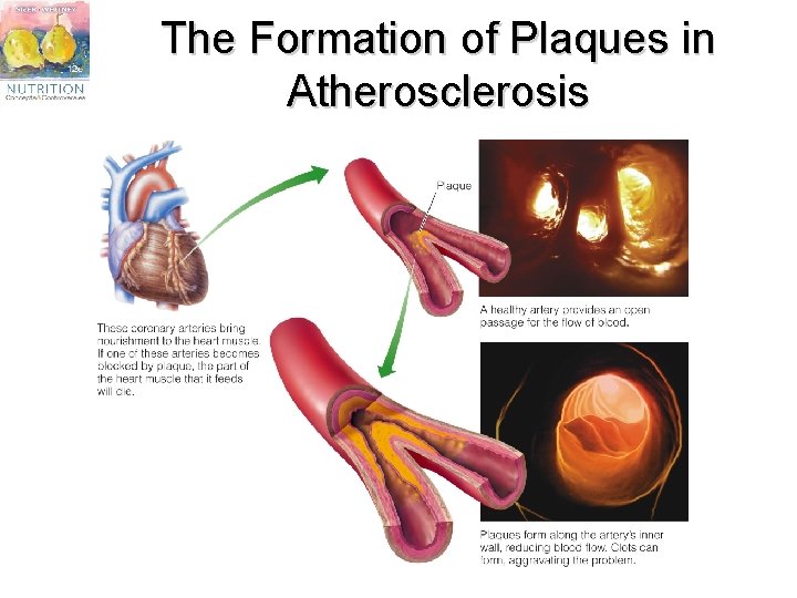 The Formation of Plaques in Atherosclerosis 