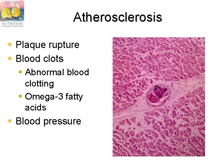 Atherosclerosis § Plaque rupture § Blood clots § Abnormal blood clotting § Omega-3 fatty