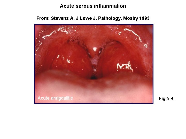 Acute serous inflammation From: Stevens A. J Lowe J. Pathology. Mosby 1995 Acute amigdalitis
