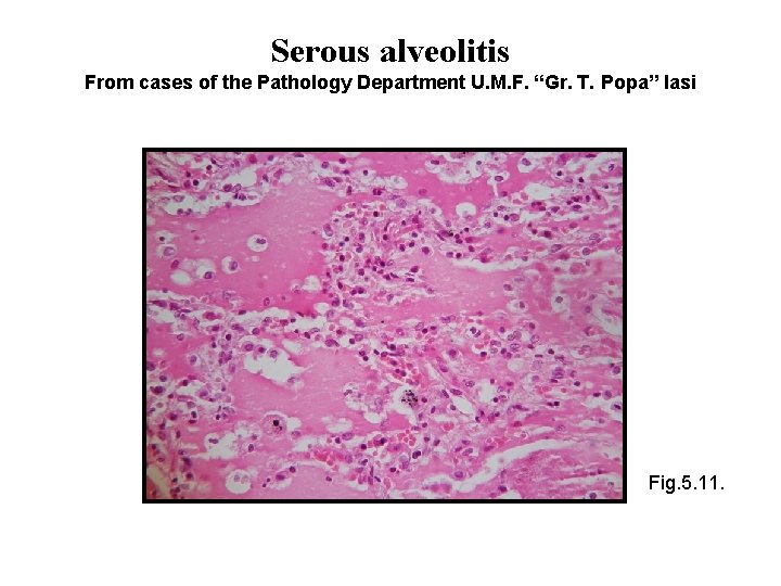 Serous alveolitis From cases of the Pathology Department U. M. F. “Gr. T. Popa”