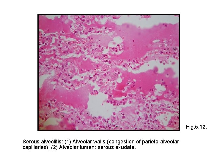 Fig. 5. 12. Serous alveolitis: (1) Alveolar walls (congestion of parieto-alveolar capillaries); (2) Alveolar