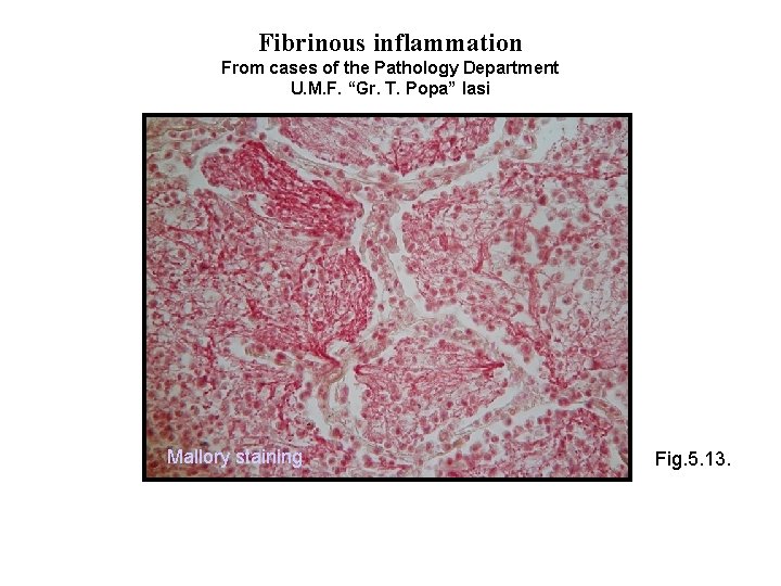 Fibrinous inflammation From cases of the Pathology Department U. M. F. “Gr. T. Popa”