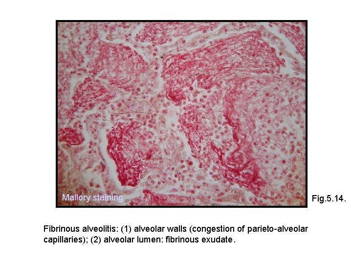 Mallory staining Fibrinous alveolitis: (1) alveolar walls (congestion of parieto-alveolar capillaries); (2) alveolar lumen: