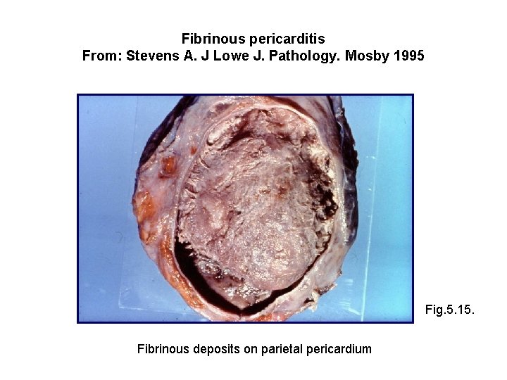 Fibrinous pericarditis From: Stevens A. J Lowe J. Pathology. Mosby 1995 Fig. 5. 15.