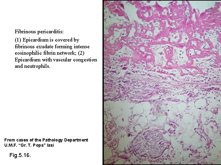 Fibrinous pericarditis: (1) Epicardium is covered by fibrinous exudate forming intense eosinophilic fibrin network;