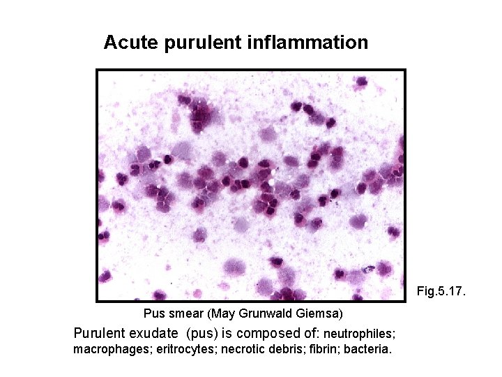 Acute purulent inflammation Fig. 5. 17. Pus smear (May Grunwald Giemsa) Purulent exudate (pus)